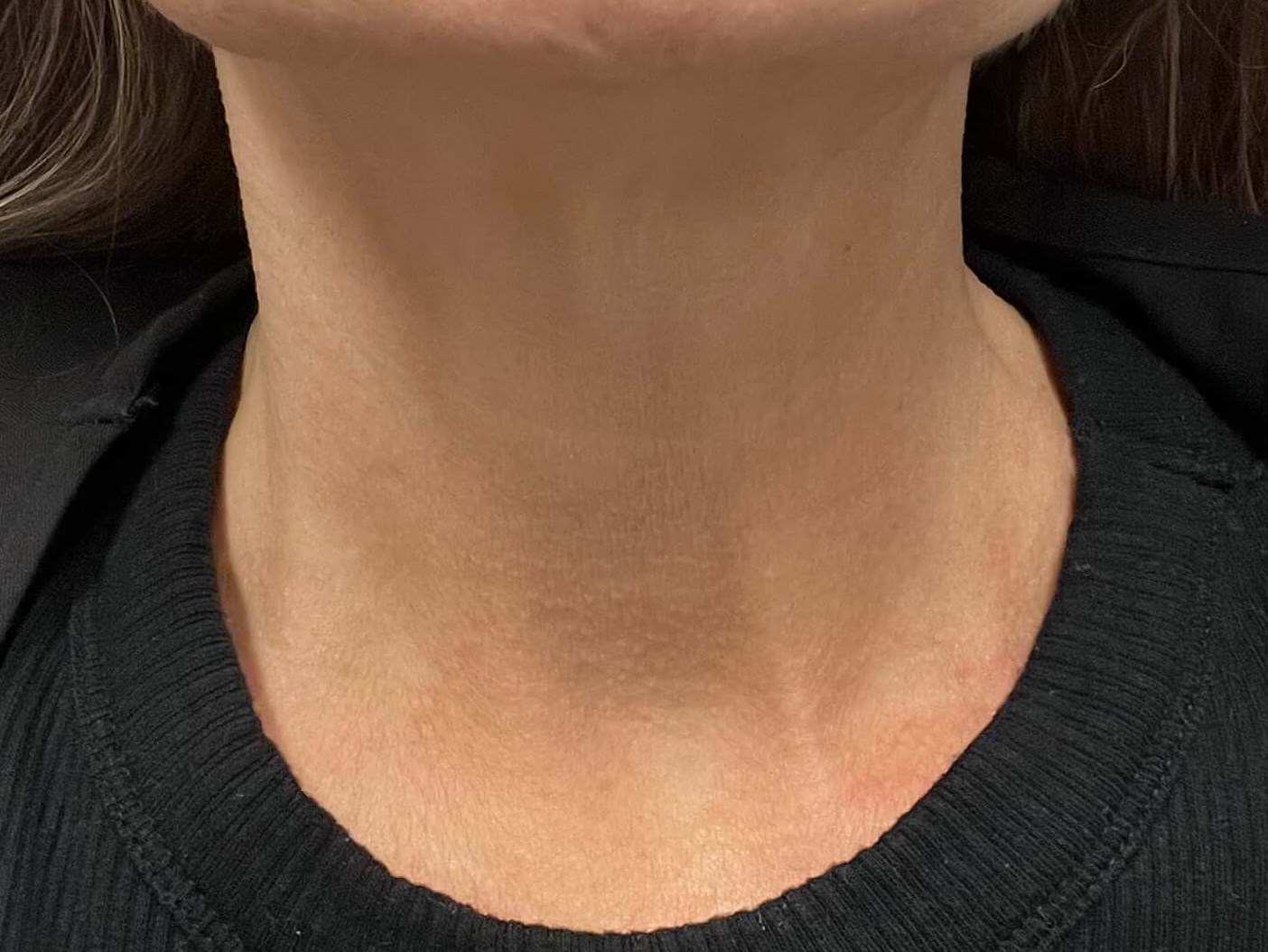 Botox platysmal bands After