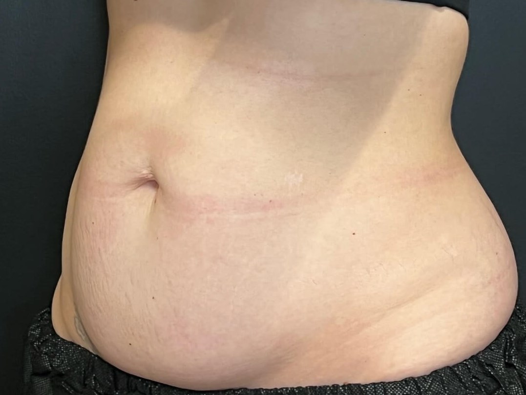 CoolSculpting Abdomen Before
