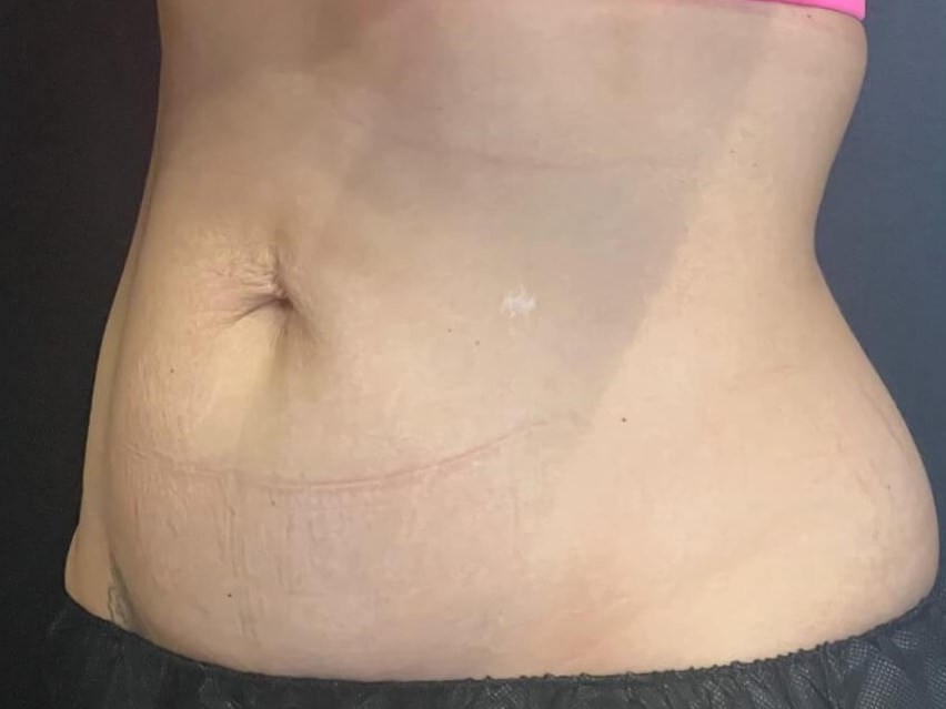 CoolSculpting Abdomen After