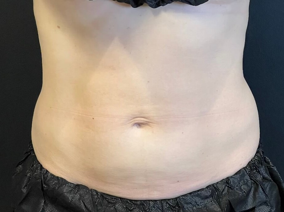 CoolSculpting Abdomen Before