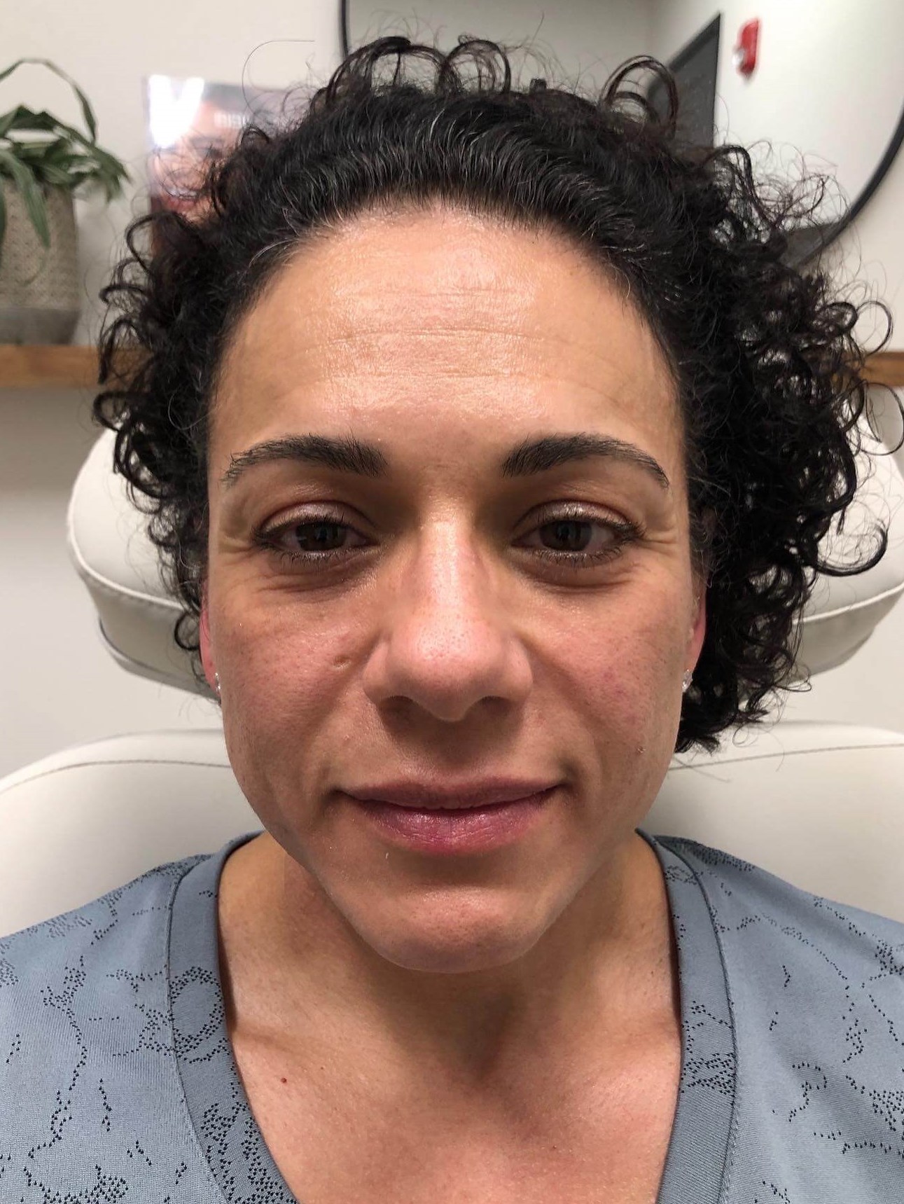 Juvederm Face Enhancement Before