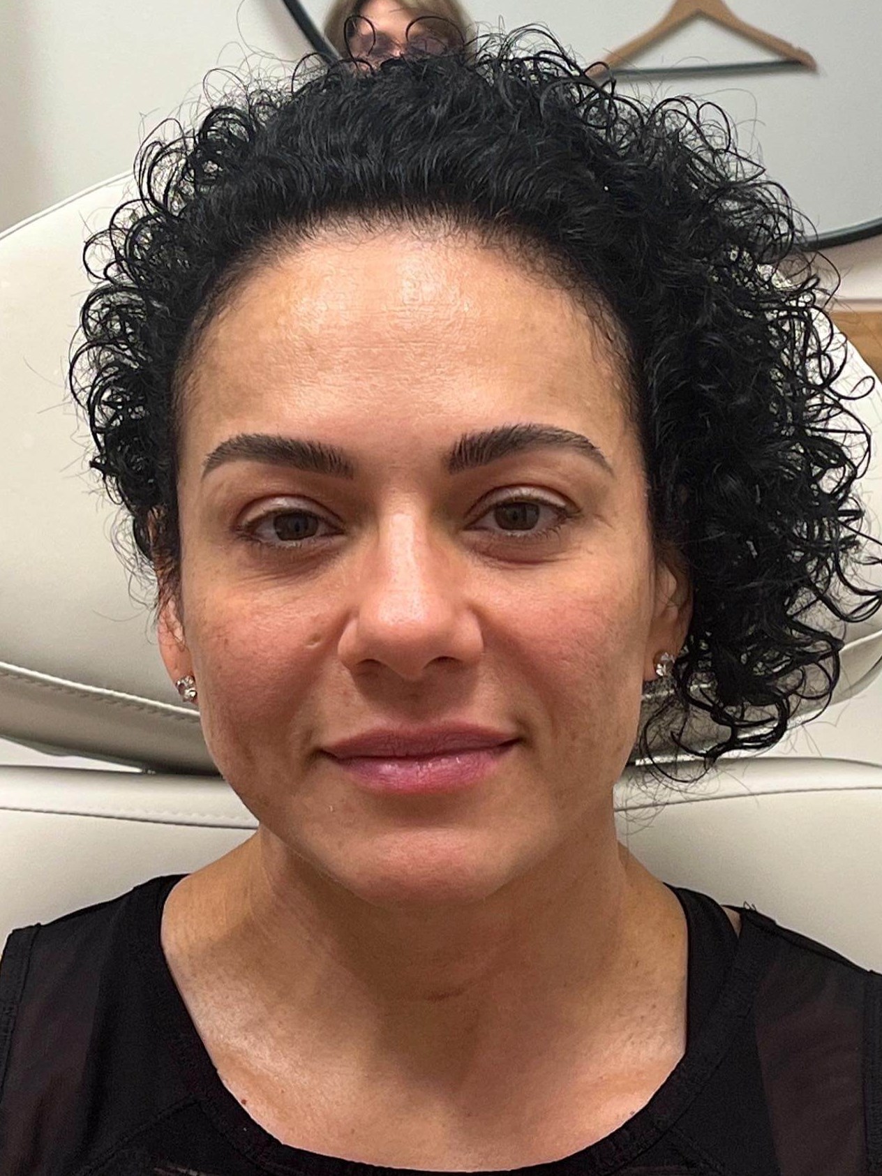 Juvederm Face Enhancement After