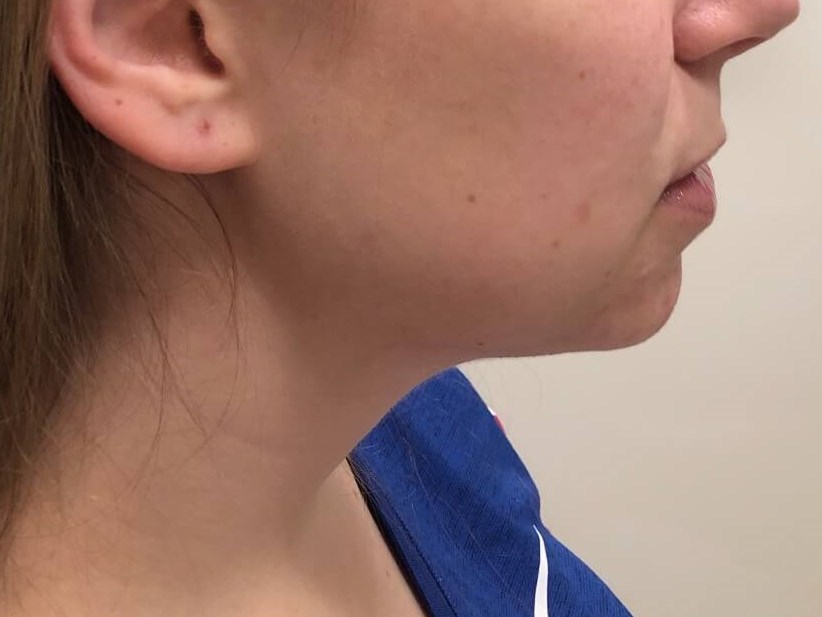 Restylane Chin Enhancement Before