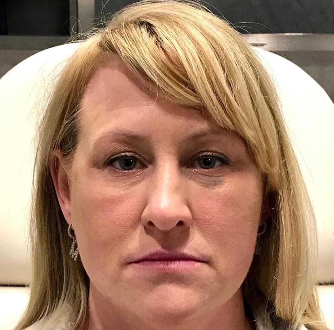 Juvederm Face Enhancement Before