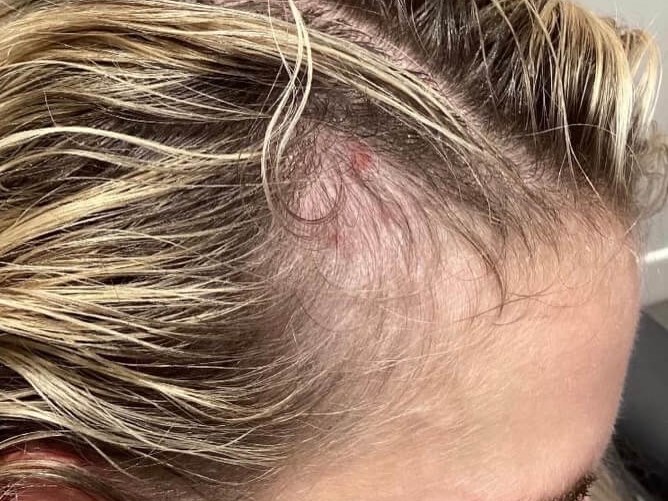 PRP Hair Restoration Before