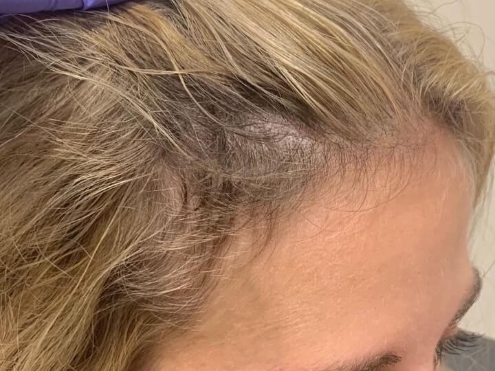 PRP Hair Restoration After