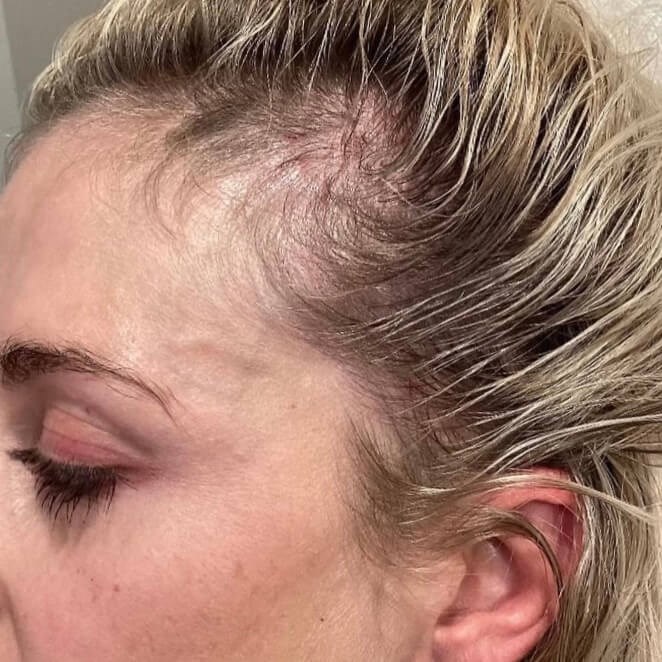 PRP Hair Restoration Before