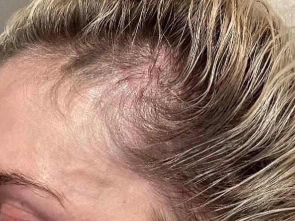 PRP Hair Restoration Before