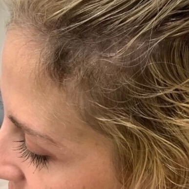 PRP Hair Restoration After