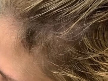 PRP Hair Restoration After