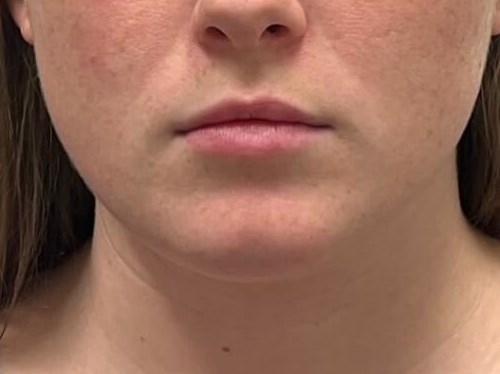 Massetter Botox Before