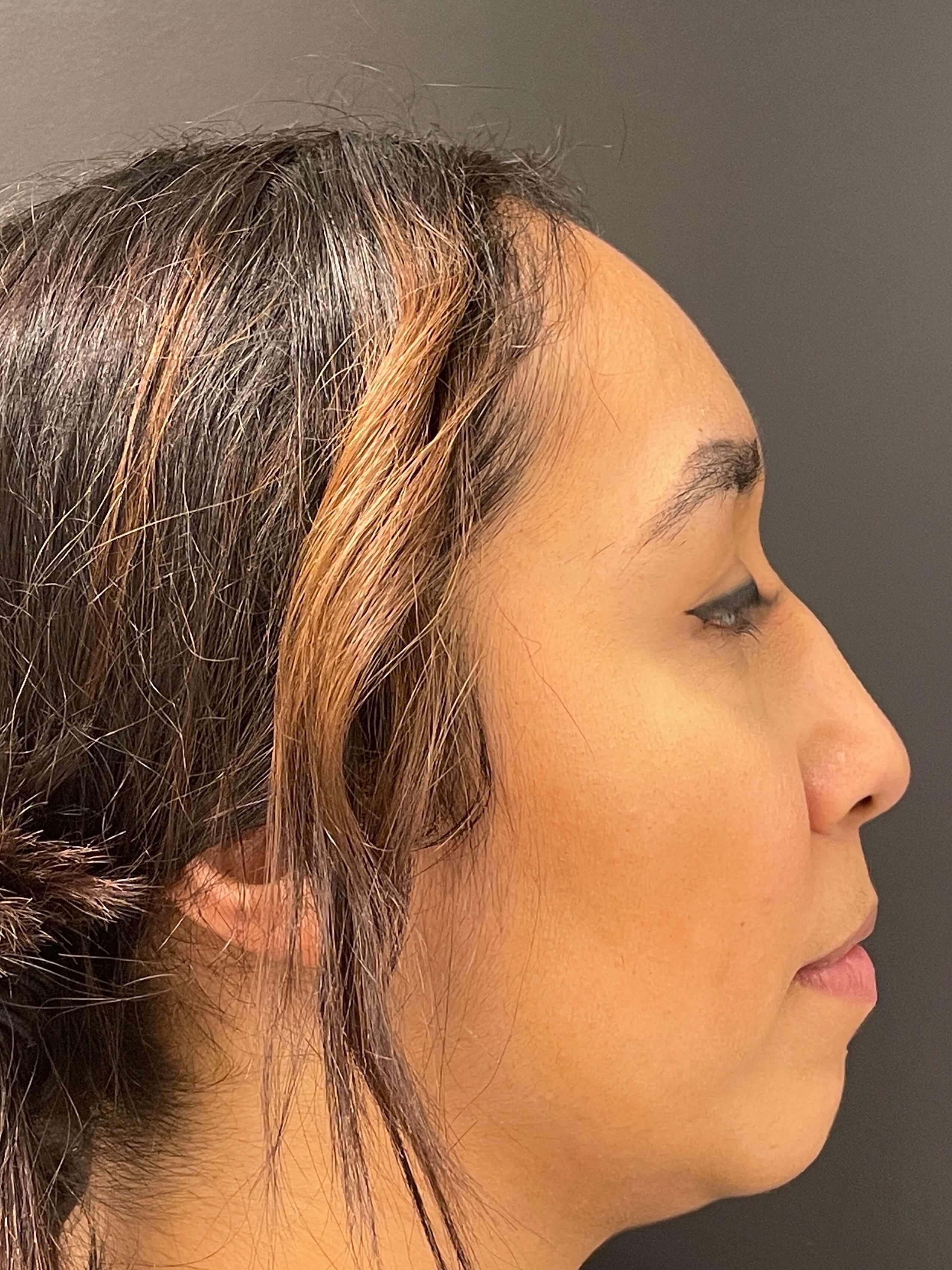Juvederm Chin Enhancement Before