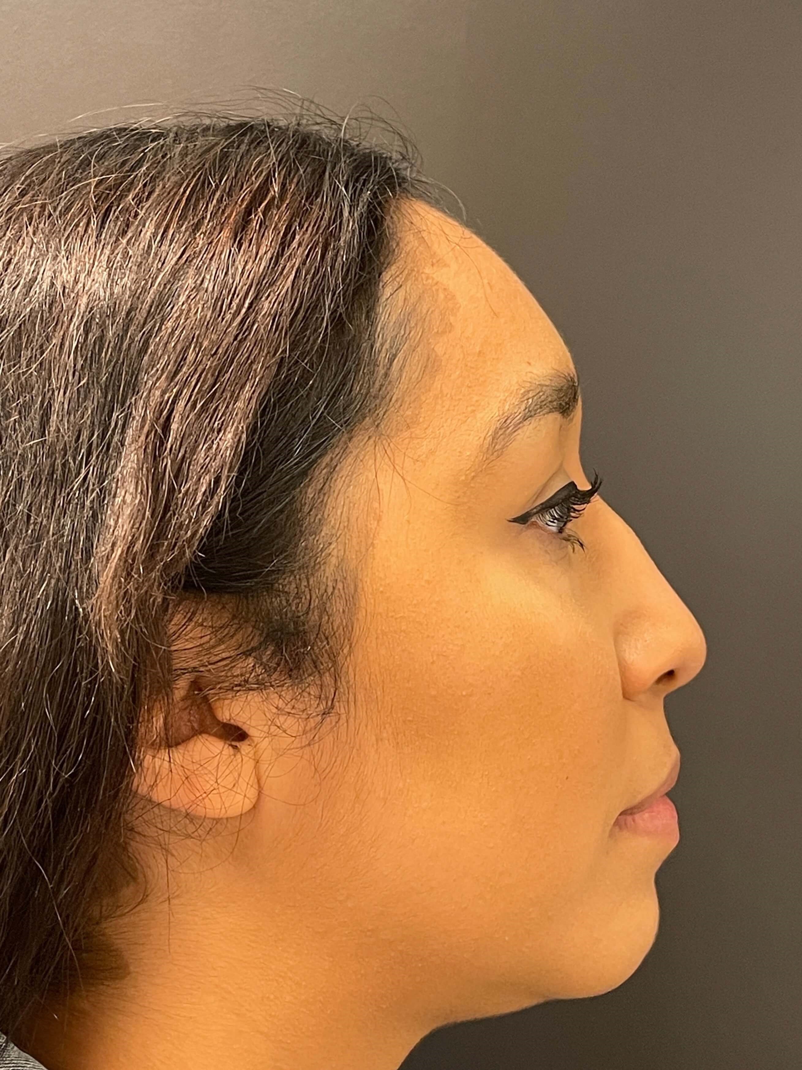 Juvederm Chin Enhancement After