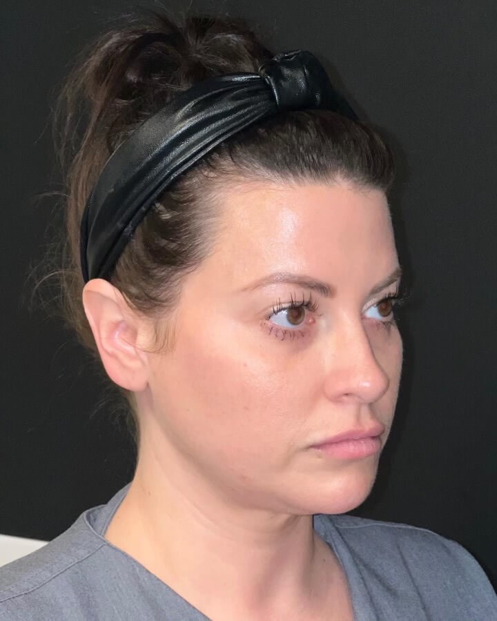 Juvederm Volux Jawline Before