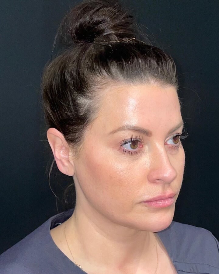 Juvederm Volux Jawline After