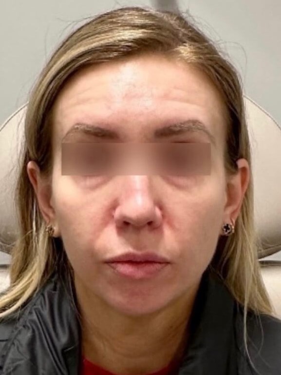 Juvederm Face Enhancement Before
