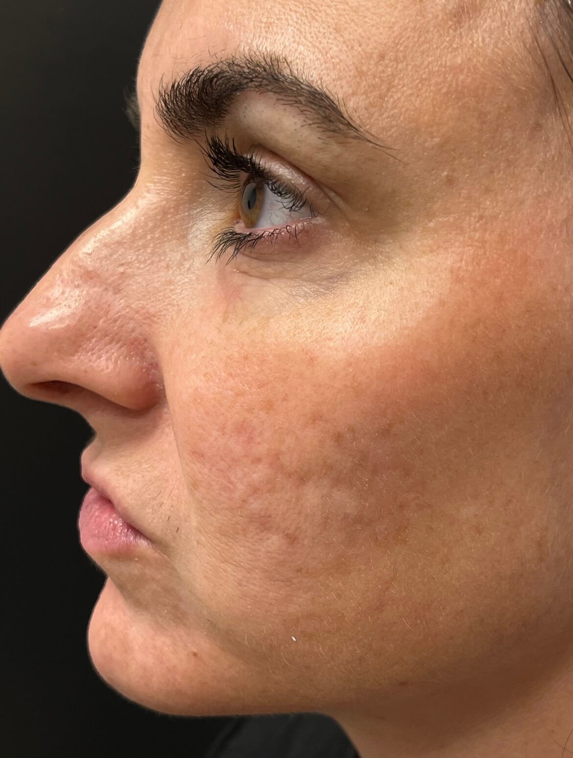 Sylfirm Acne Scars Before