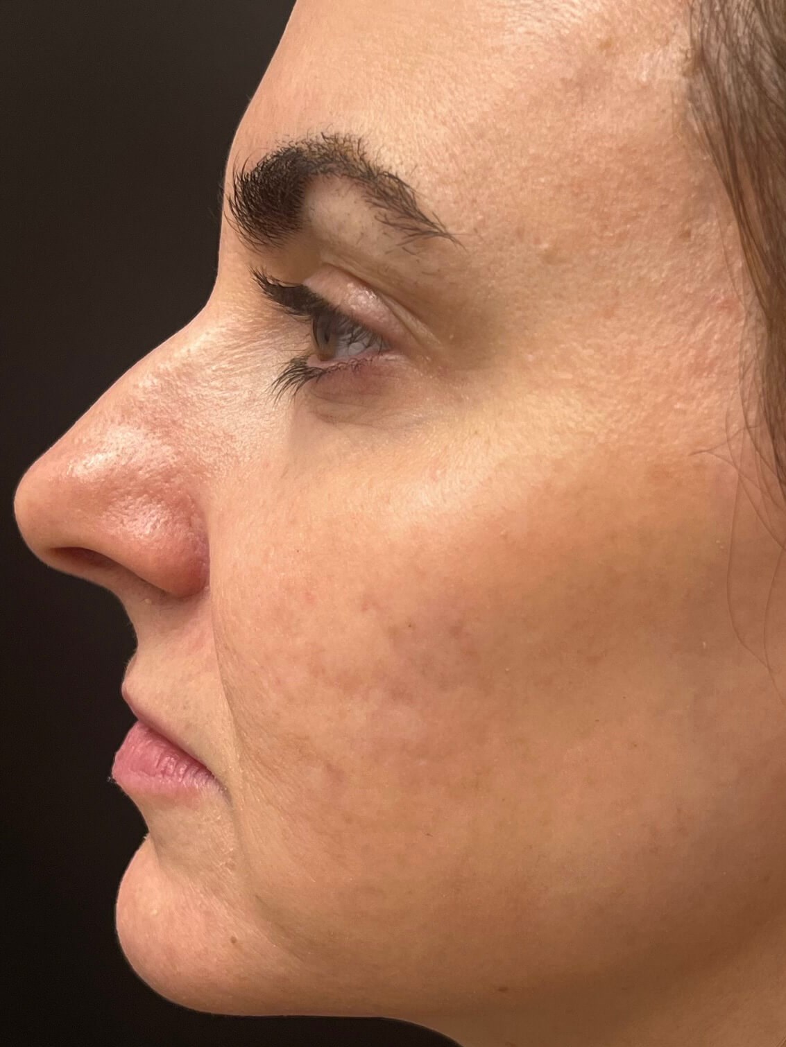 Sylfirm Acne Scars After