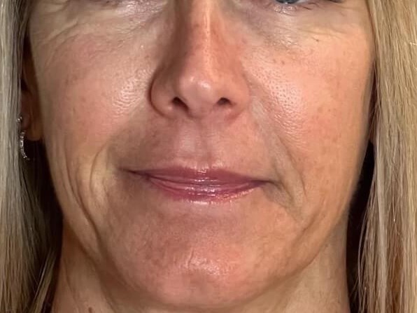 Sylfirm Skin Tightening Before