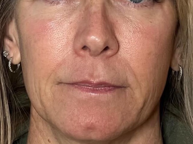 Sylfirm Skin Tightening After