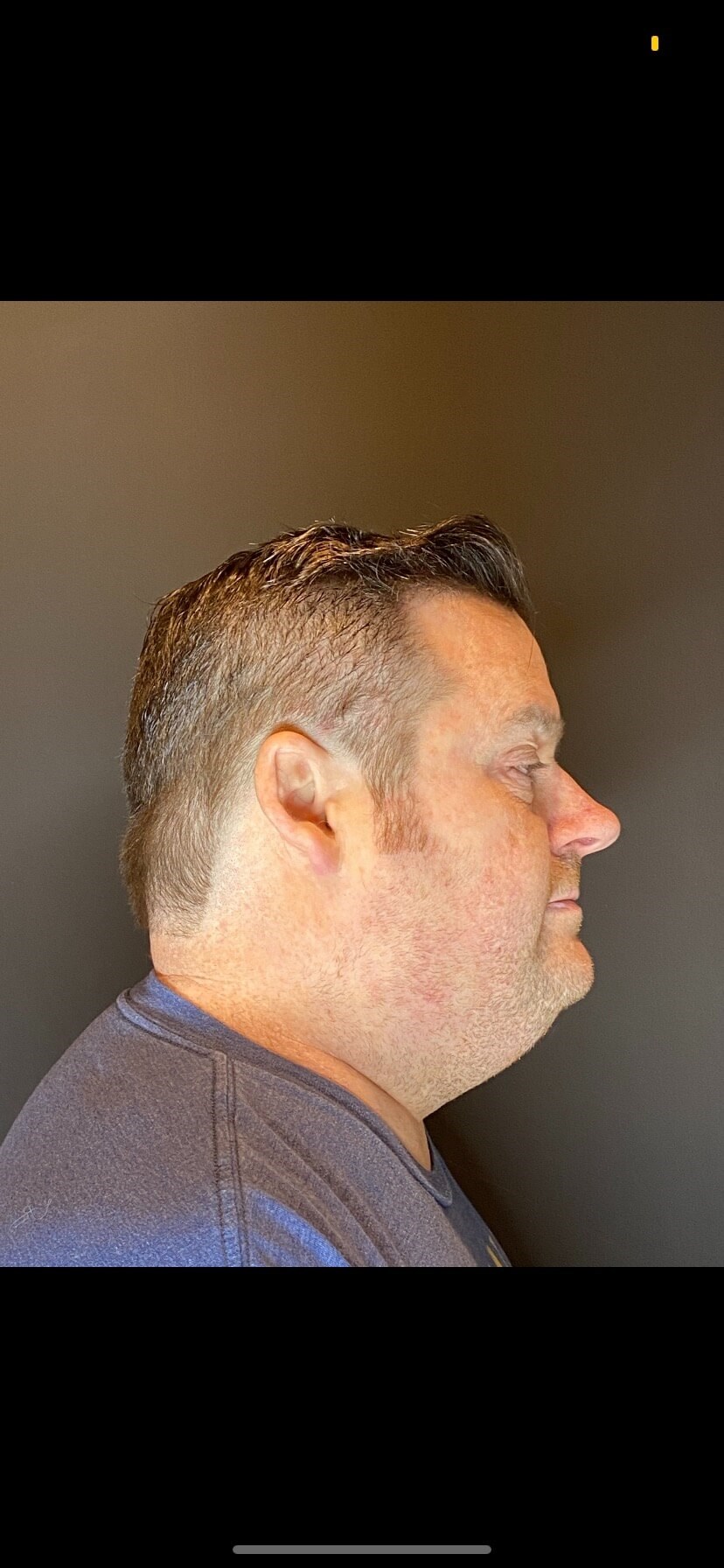 CoolSculpting  Chin Before