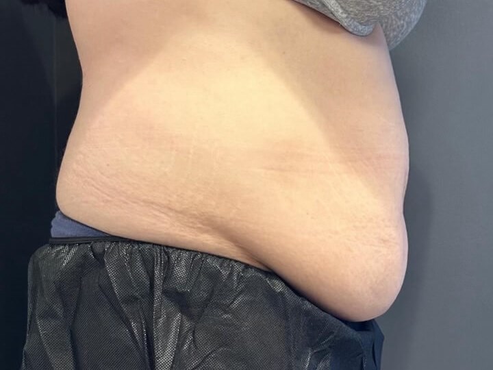 CoolSculpting Abdomen Before