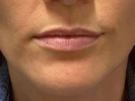 Juvederm Lip Enhancement Before