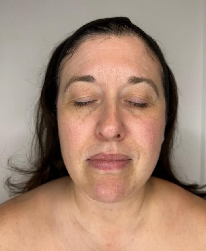 BBL Photo Facial After