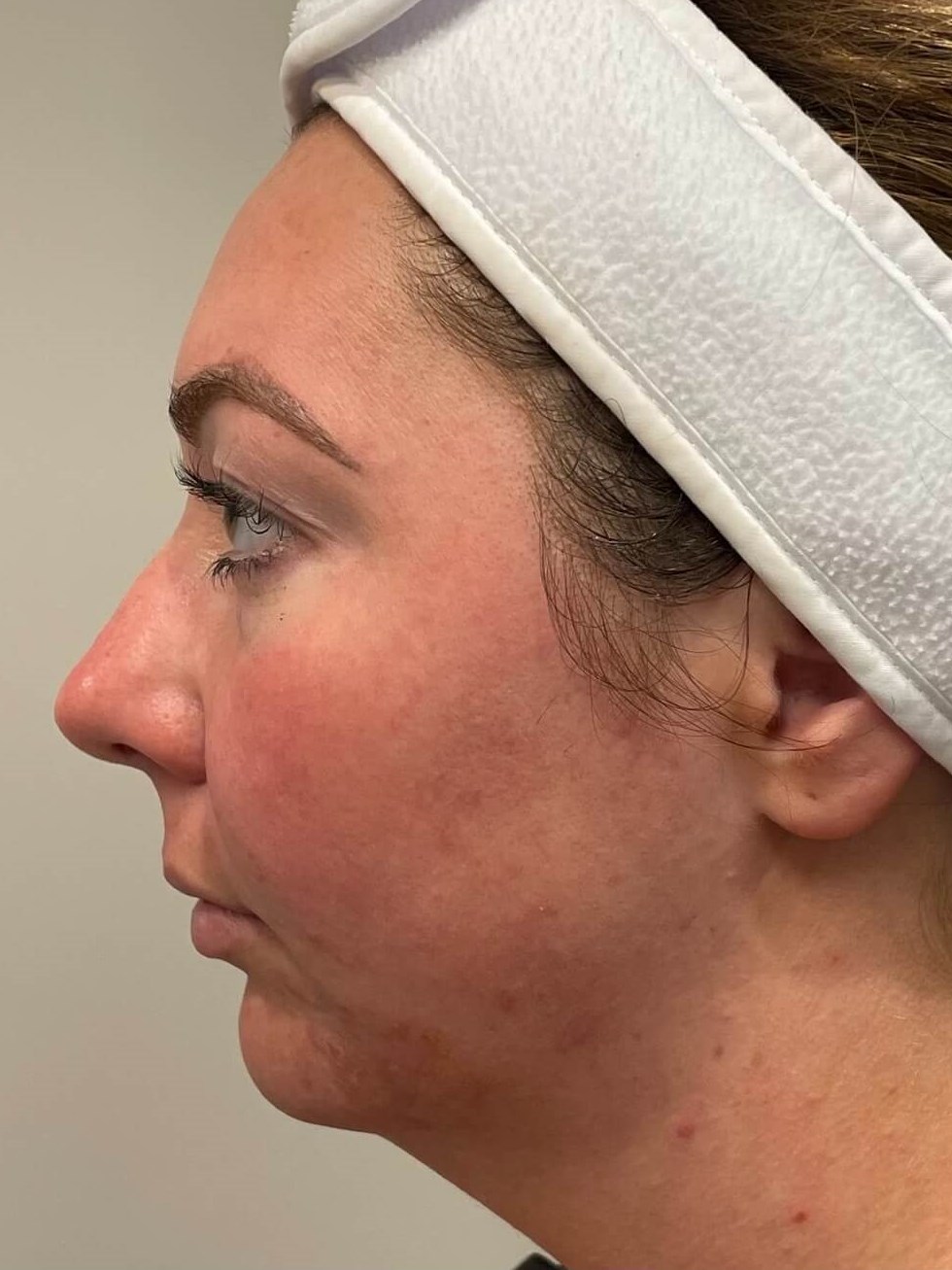 BBL Photo Facial Before