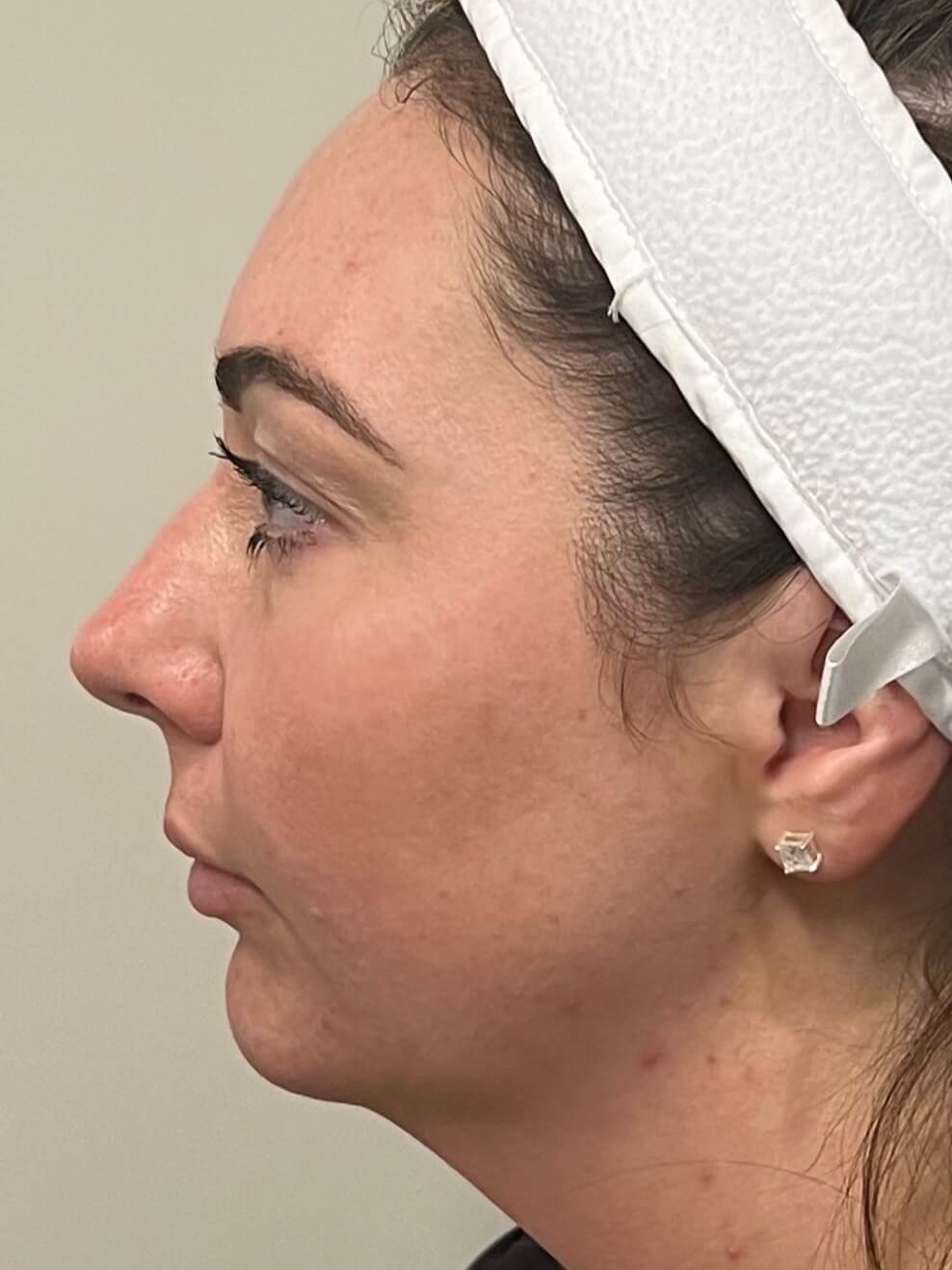 BBL Photo Facial After