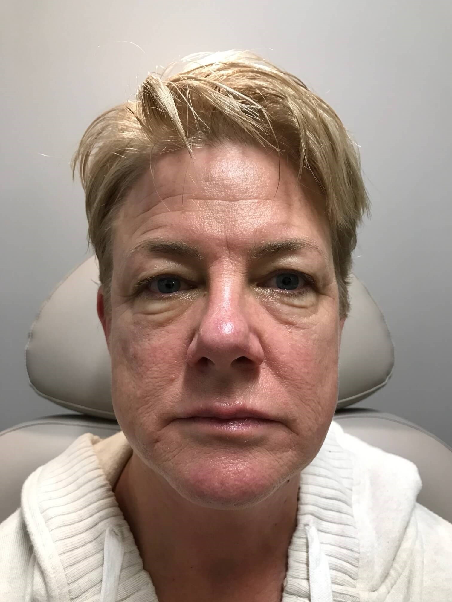Juvederm Face Enhancement Before