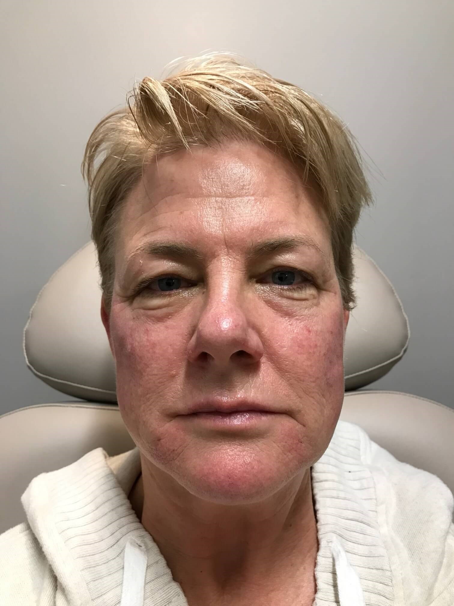 Juvederm Face Enhancement After