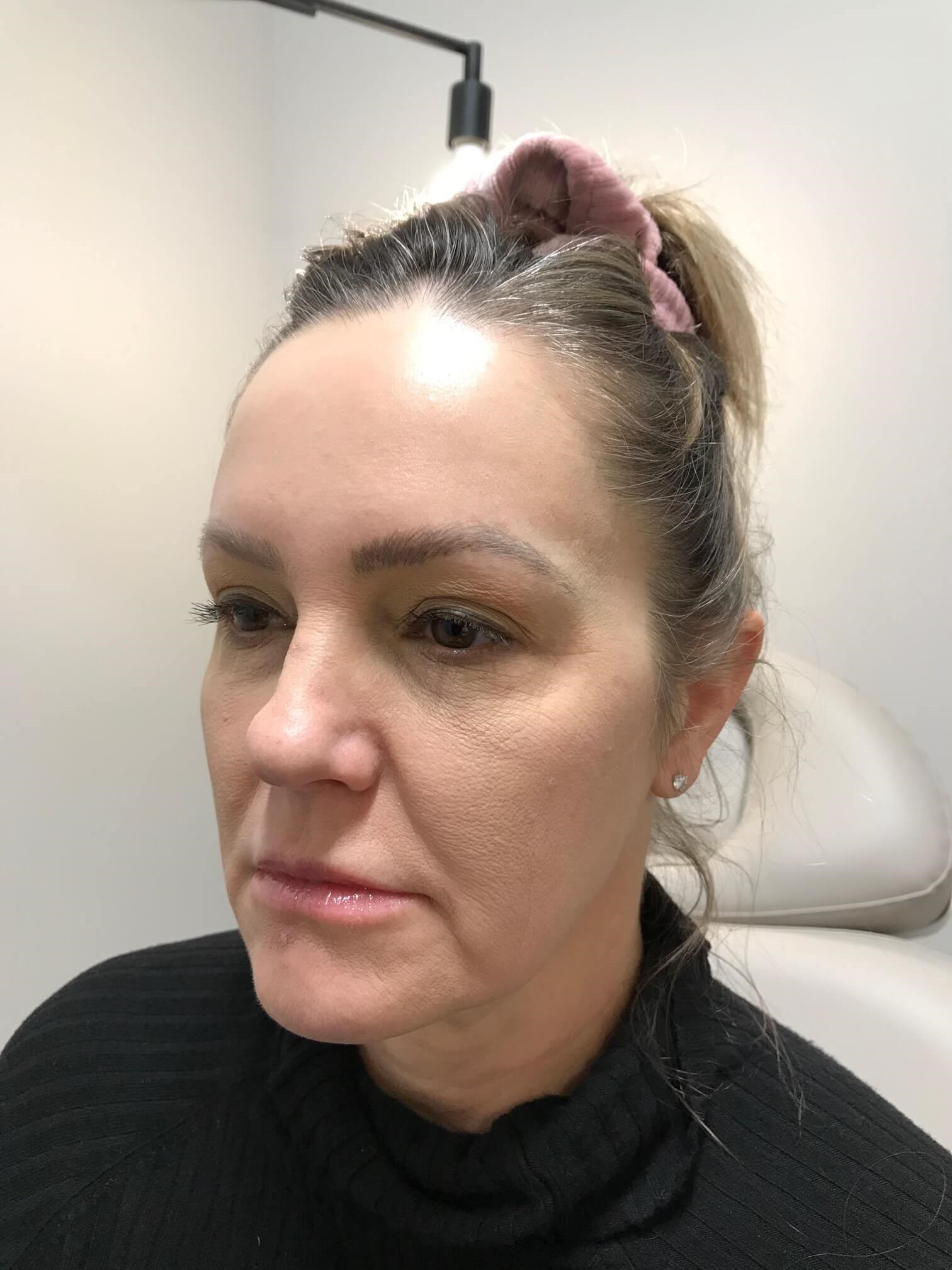 Juvederm Face Enhancement Before
