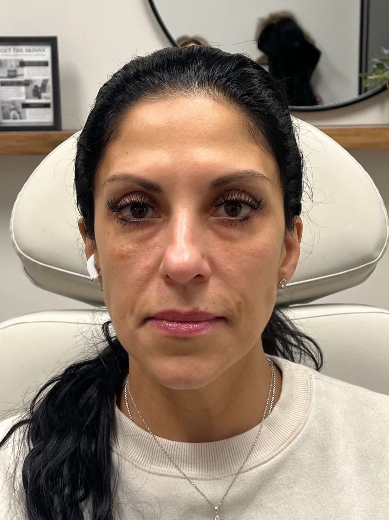 Juvederm Face Enhancement Before