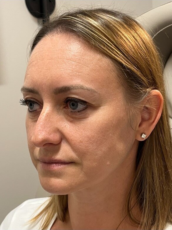 Juvederm Face Enhancement Before