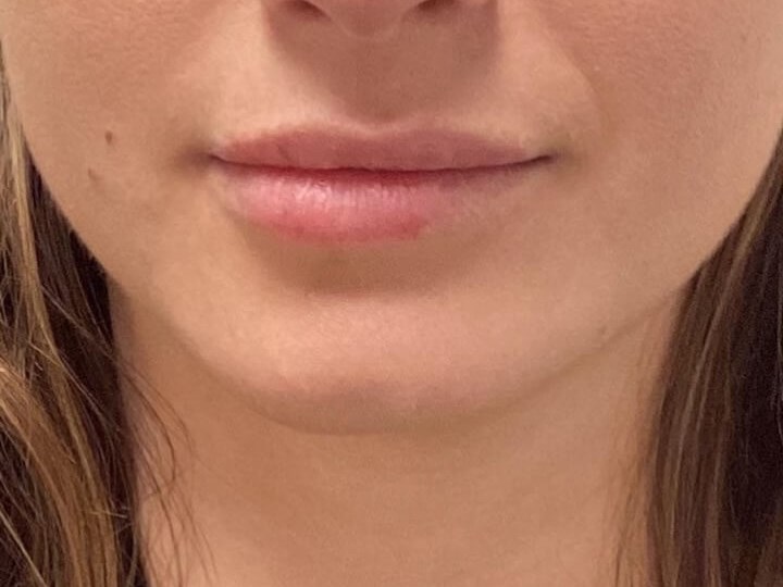 Juvederm Lip Enhancement Before