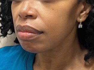 Juvederm Face Enhancement Before