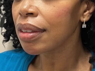 Juvederm Face Enhancement After