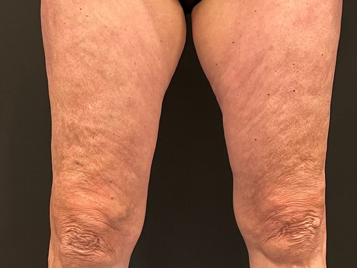 Exilis Skin Tightening Before