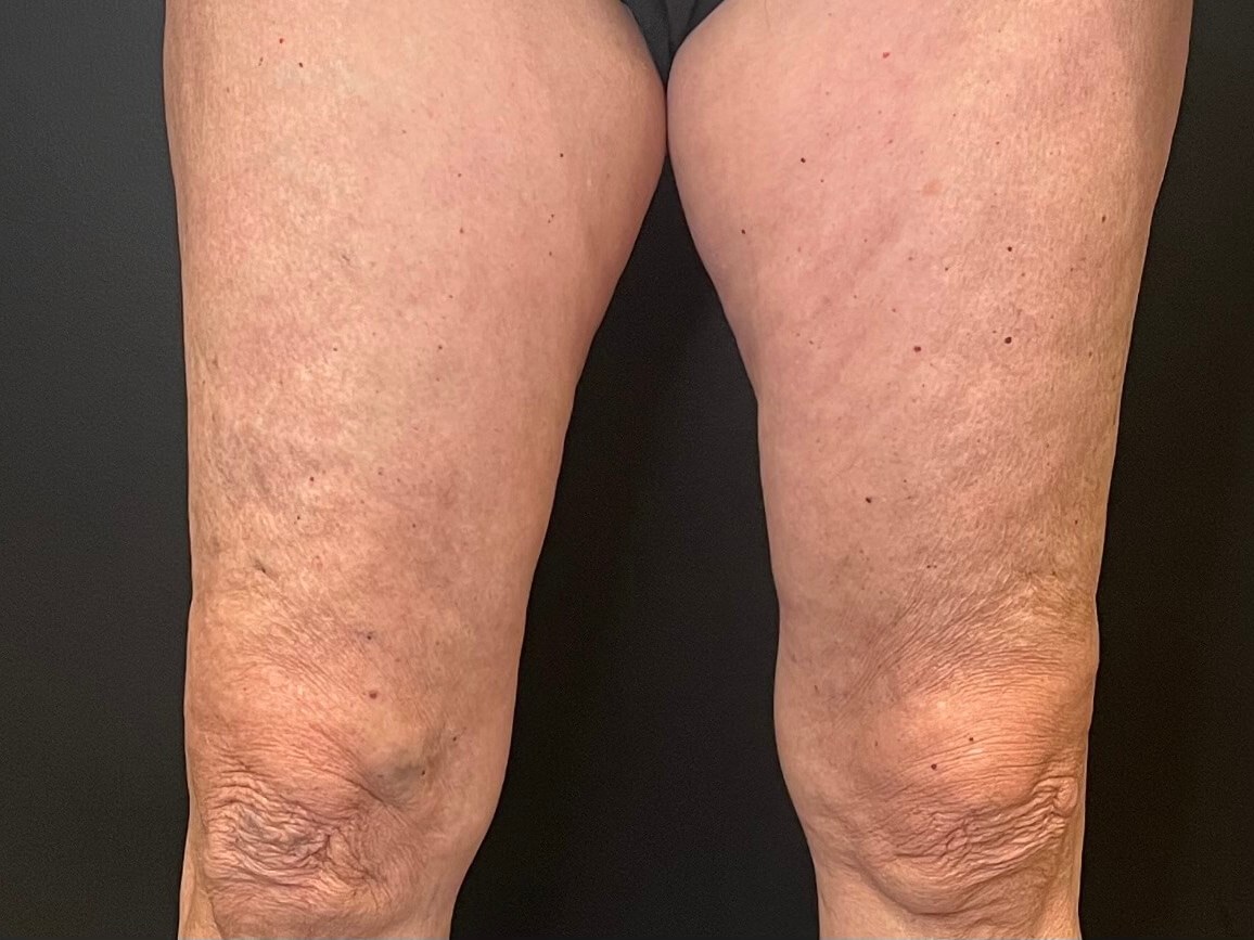 Exilis Skin Tightening After