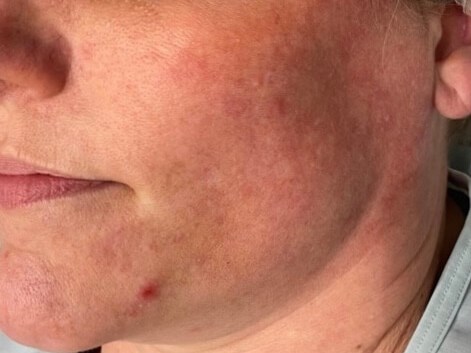 BBL Photo Facial Before
