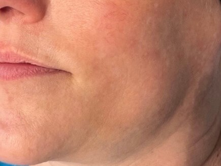 BBL Photo Facial After