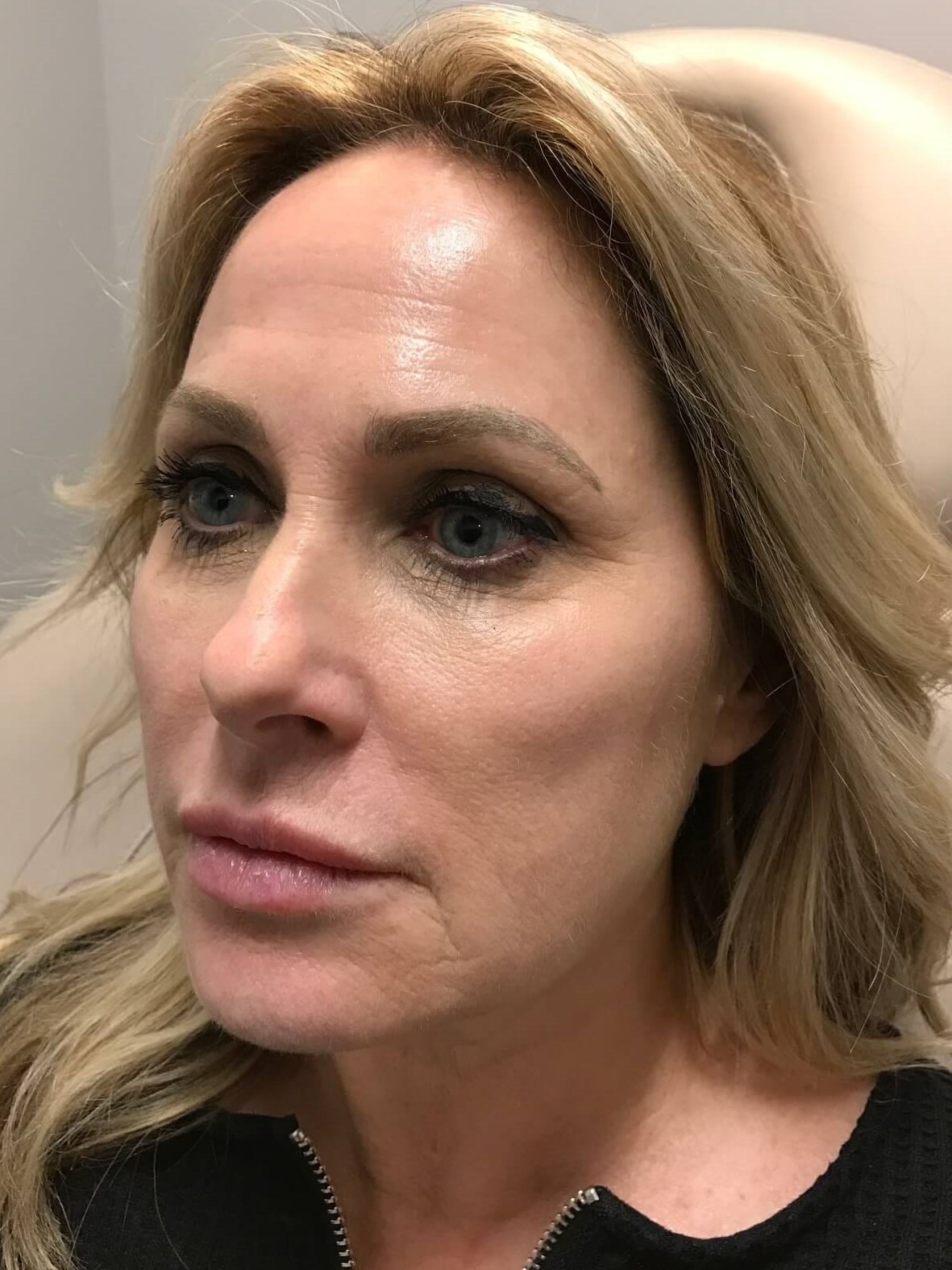 Juvederm Face Enhancement Before