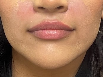 Juvederm Lip Enhancement Before