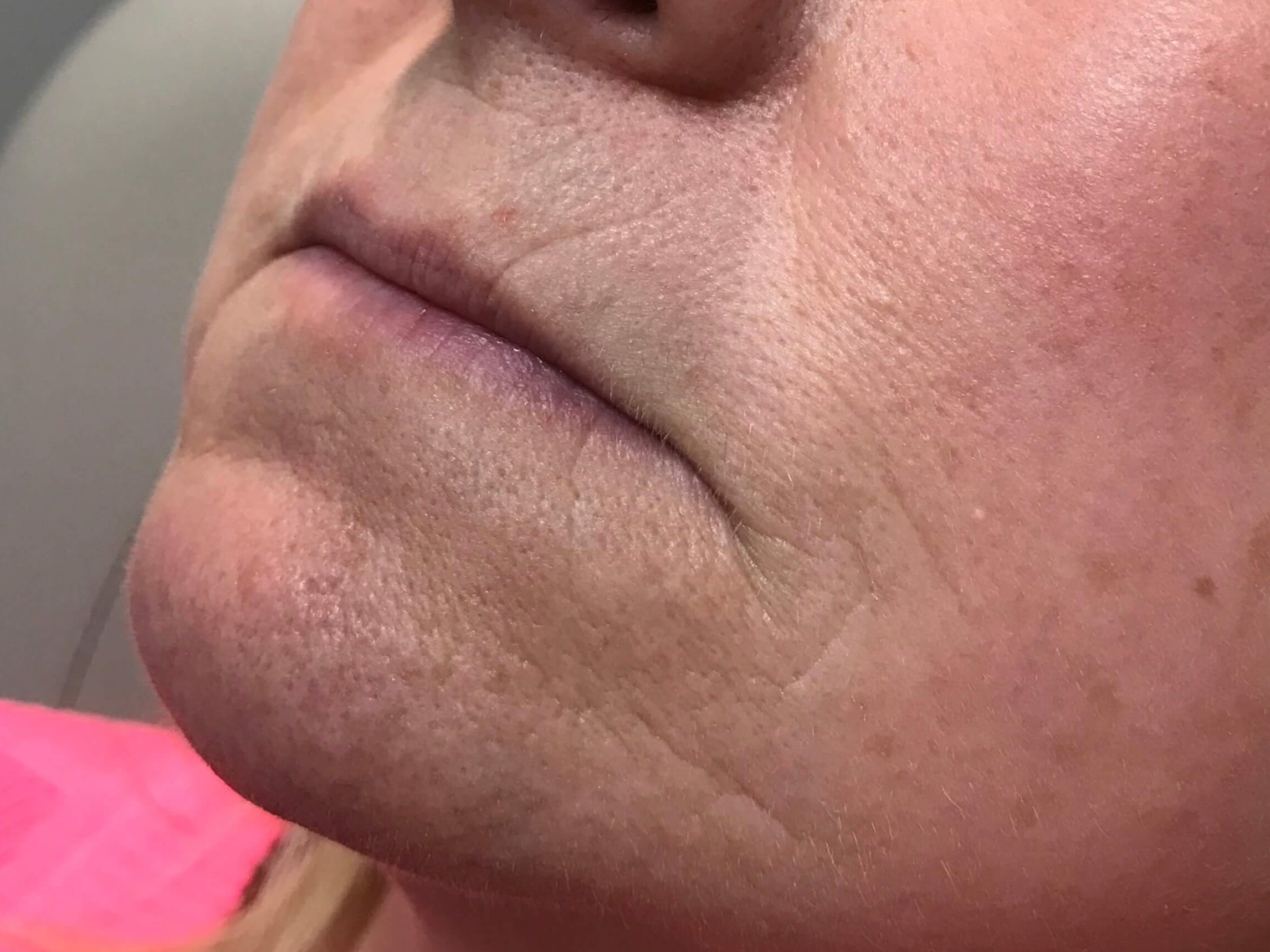 Juvederm Lip Enhancement Before