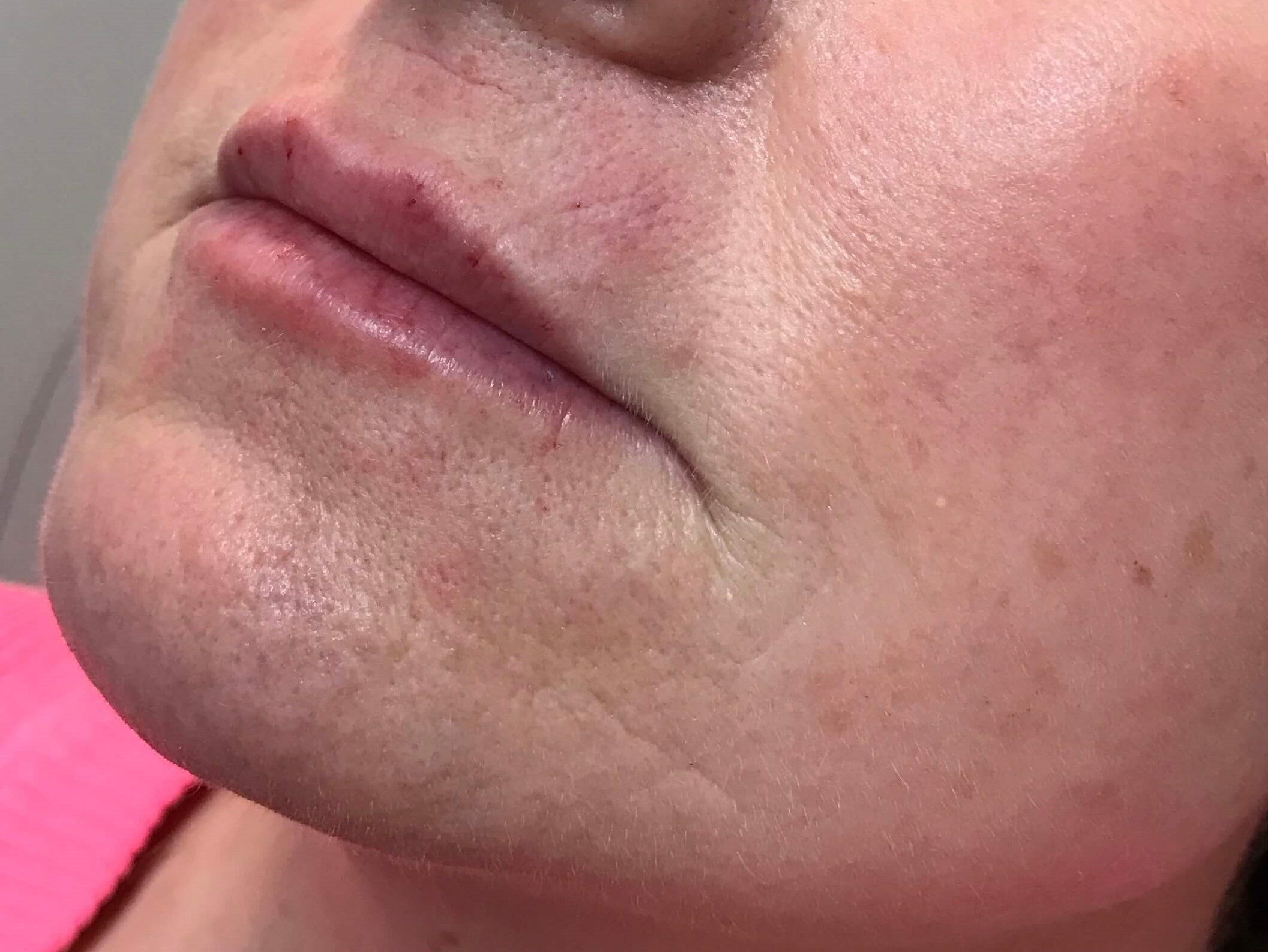Juvederm Lip Enhancement After