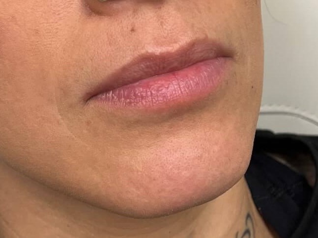 Juvederm Lip Enhancement Before