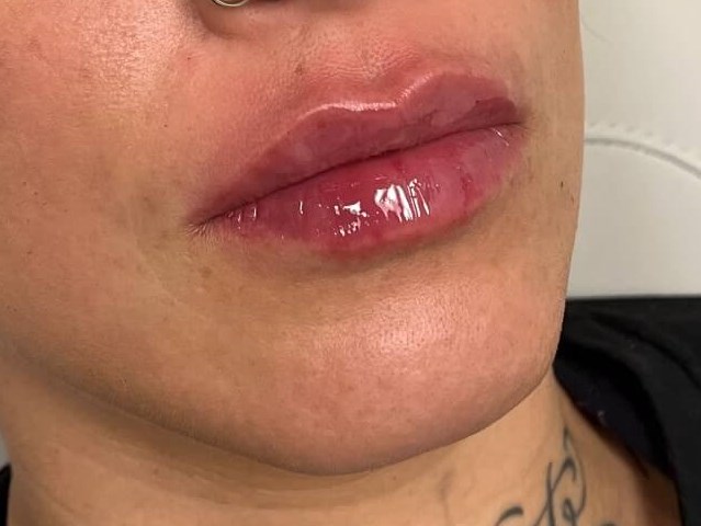 Juvederm Lip Enhancement After