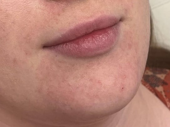 Juvederm Lip Enhancement Before