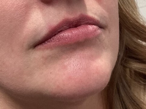Juvederm Lip Enhancement Before